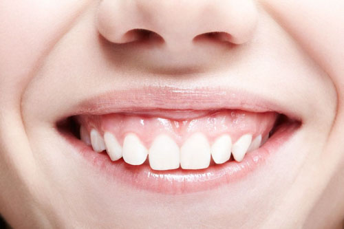 Tình trạng cười hở lợi dễ dàng nhận biết khi trẻ đã thay đầy đủ răng vĩnh viễn