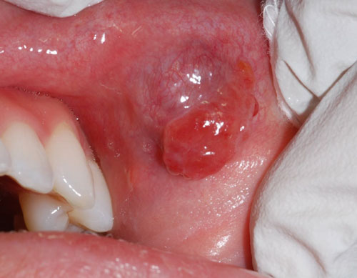 Ung thư miệng có thể chữa khỏi nếu kịp thời điều trị trong giai đoạn đầu