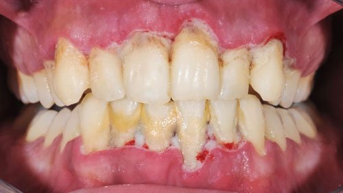 Viêm nha chu cũng là tác nhân gây sưng lợi răng cửa thường gặp
