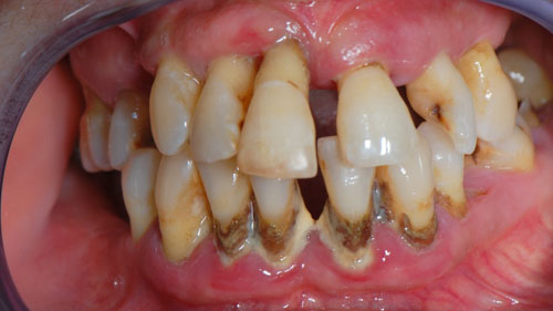 Viêm nha chu gây tiêu xương và mất răng hàng loạt