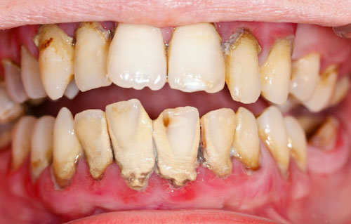 Viêm nha chu là bệnh lý răng miệng nguy hiểm gây ra do vi khuẩn