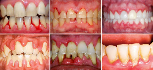 Bệnh răng miệng dễ phát sinh nặng nếu không khám răng thường xuyên