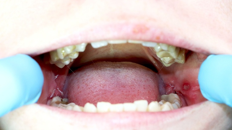 Biến chứng sau khi nhổ răng khôn do nhiễm trùng hình thành tổn thương