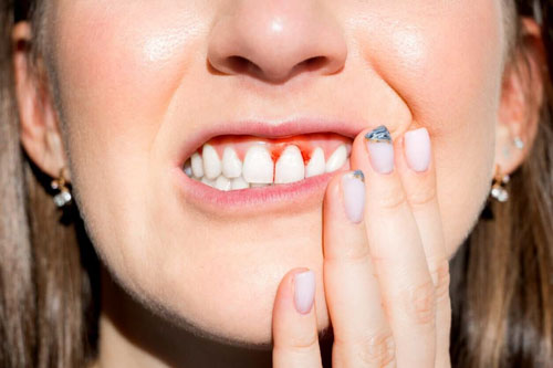 Bọc răng sứ bị viêm lợi gây nhiều triệu chứng khó chịu
