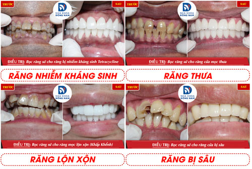 Bọc răng sứ tại Nha khoa Đông Nam đảm bảo an toàn, hiệu quả và thẩm mỹ cao