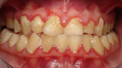 Các bệnh răng miệng phải được điều trị dứt điểm trước khi bọc sứ