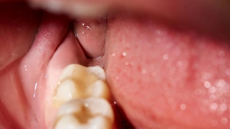 Các triệu chứng bất thường vẫn xảy ra sau 3 – 4 ngày nhổ răng khôn