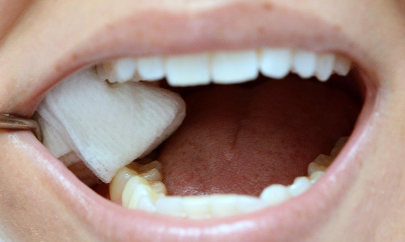 Cắn chặt bông gạc để cầm máu