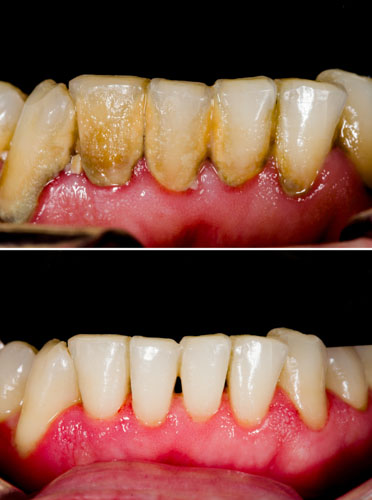 Cạo vôi răng làm sạch mảng bám gây viêm nhiễm hiệu quả