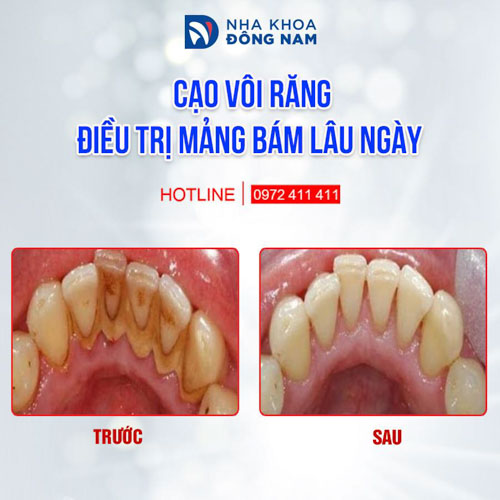 Cạo vôi răng loại bỏ mảng bám gây viêm nướu