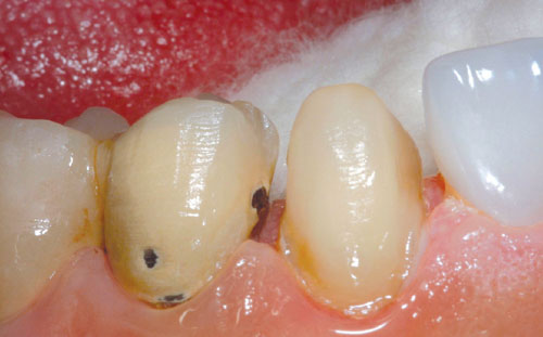 Cắt răng sứ cũ và tinh chỉnh lại đường mài răng cho chuẩn xác