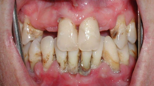Điều trị ê buốt ngay để tránh nguy cơ mất răng