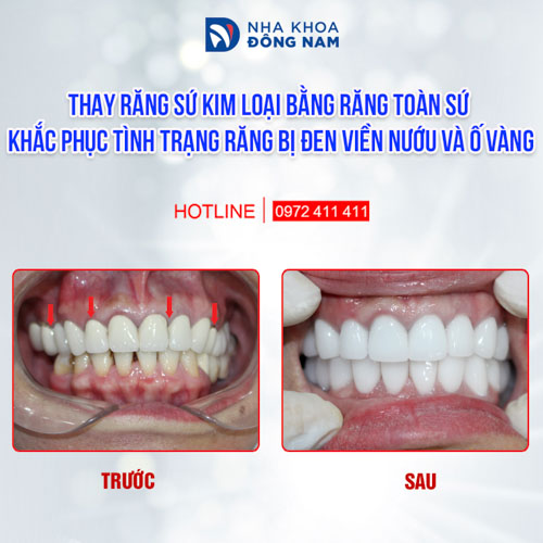 Nên chọn dùng răng toàn sứ để đảm bảo an toàn, không kích ứng