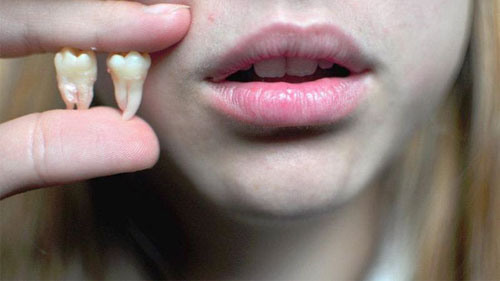 Nhổ răng vào buổi sáng giúp người bệnh theo dõi được quá trình lành thương