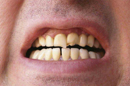 Răng bị gãy mẻ cũng trở nên nhạy cảm hơn