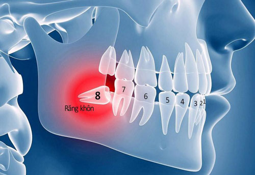 Răng khôn là chiếc răng nằm cuối cùng trong trên cung hàm