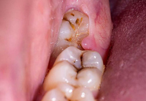 Răng khôn mọc lệch gây ảnh hưởng đến răng bên cạnh cần được nhổ bỏ sớm