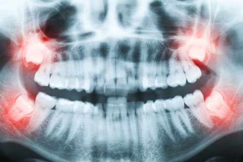 Răng khôn mọc lệch, mọc ngầm trong xương hàm