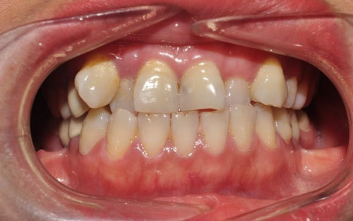Răng mọc lệch lạc khó vệ sinh sạch, dễ mắc bệnh lý