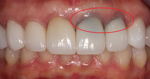 Răng sứ kim loại dễ gây kích ứng nếu bệnh nhân dị ứng vật liệu này