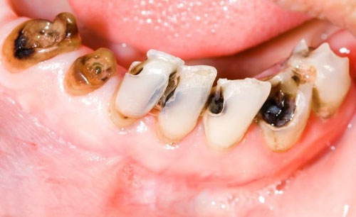 Sâu răng gây nhiều cơn đau nhức, khó chịu