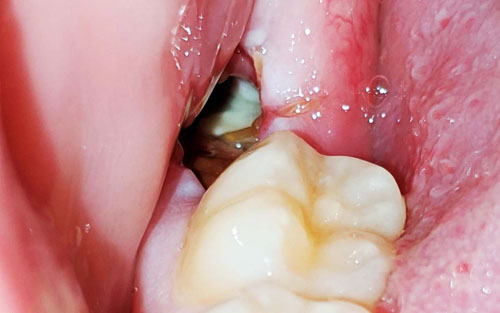 Tình trạng ổ răng khô sau khi nhổ răng khôn gây ra những cơn đau khó chịu