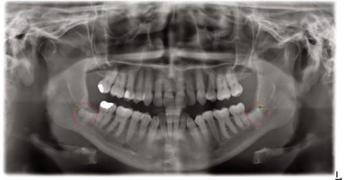 Trường hợp giải phẫu khó bác sĩ sẽ giữ lại chân răng khôn để quan sát thêm