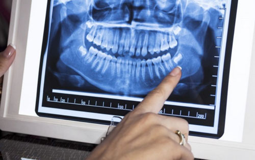 Việc nhổ 4 răng khôn cùng lúc phụ thuộc vào quyết định từ bác sĩ chuyên môn