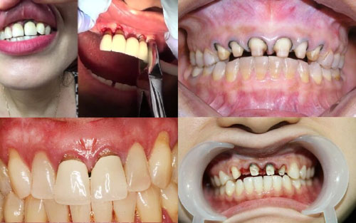 Viêm lợi sau bọc sứ gây nhiều mối nguy hại cho sức khỏe răng miệng