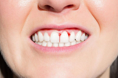 Viêm nướu chảy máu chân răng là biến chứng của bọc răng sứ bị lệch khớp cắn