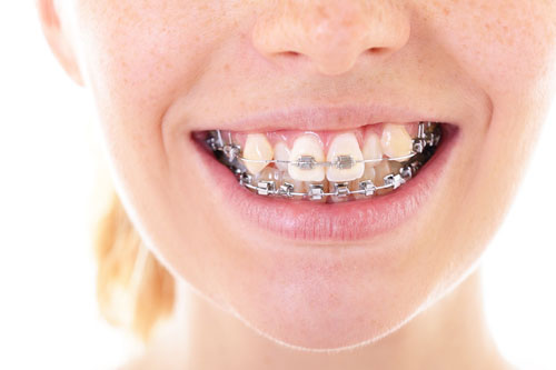 3 – 6 tháng đầu có lẽ là giai đoạn xấu nhất khi niềng răng