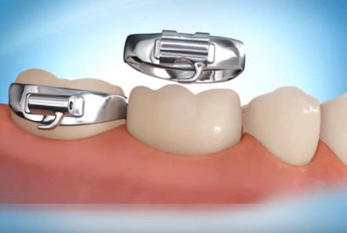 Band răng thường được gắn ở răng số 6 hoặc số 7