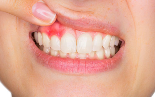 Bệnh nướu răng làm nướu tụt xuống lộ chân răng ra ngoài gây ê buốt