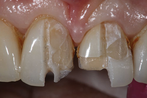 Biến chứng hỏng răng thật khi làm mặt dán sứ kém chất lượng