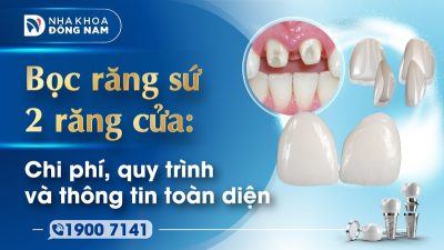 Bọc răng sứ 2 răng cửa Chi phí, quy trình và thông tin toàn diện