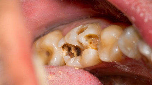 Bọc răng sứ cho chiếc răng hàm vĩnh viễn bị sâu lớn