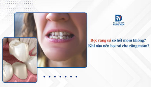 Bọc răng sứ có hết móm không? Khi nào nên bọc răng sứ cho răng móm?