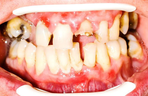 Các bệnh răng miệng gây hư hỏng cấu trúc răng nghiêm trọng