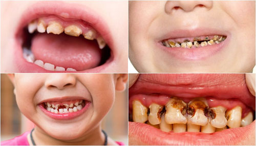 Các bệnh răng miệng khiến cấu trúc răng của trẻ hư hỏng nặng nề