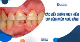 Các biến chứng nguy hiểm của bệnh viêm nướu răng