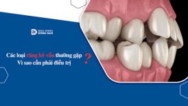 Các loại răng hô vẩu thường gặp? Vì sao cần phải điều trị?