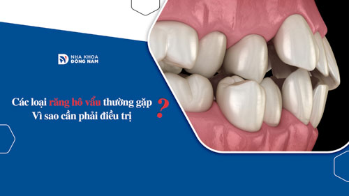 Các loại răng hô vẩu thường gặp? Vì sao cần phải điều trị?