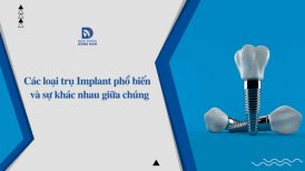 Các loại trụ Implant phổ biến hiện nay và sự khác nhau giữa chúng