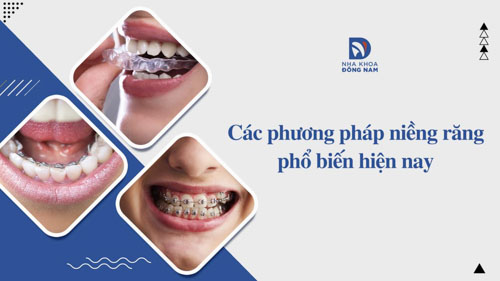 Các phương pháp niềng răng phổ biến hiện nay