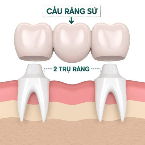 Cầu răng sứ cần mài chỉnh răng để tạo trụ đỡ