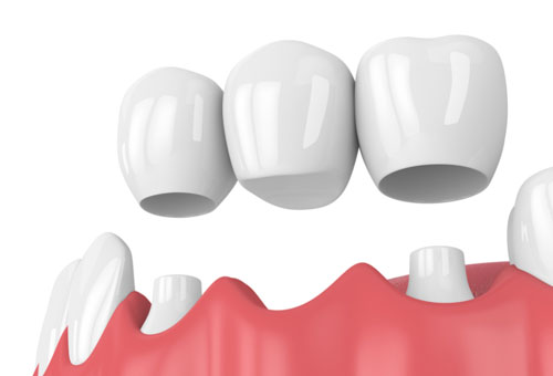 Cầu răng sứ cơ bản được áp dụng phổ biến nhất