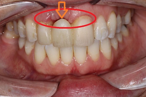 Cầu răng sứ không thể ngăn chặn quá trình tiêu xương hàm xảy ra