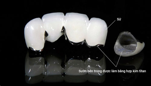 Cấu tạo của răng Titan sẽ khác biệt hơn so với các dòng răng sứ toàn sứ