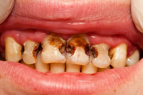 Chăm sóc răng miệng cho trẻ không đúng cách có thể gây sâu răng