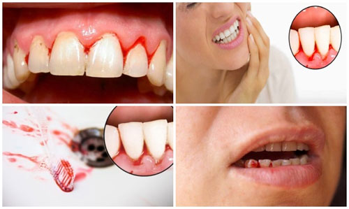 Chảy máu chân răng còn do nhiều nguyên nhân khác gây nên